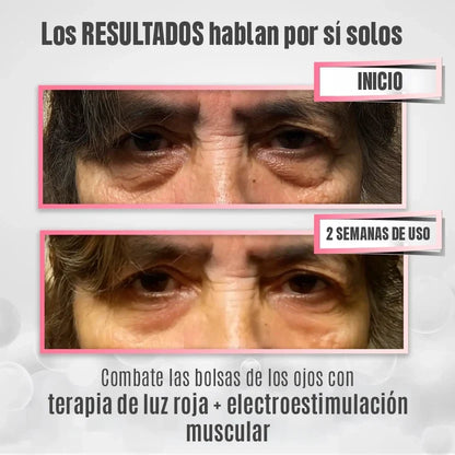RevitalEyes® 2 en 1: Terapia de Luz Roja y EMS para Eliminar Bolsas de los Ojos