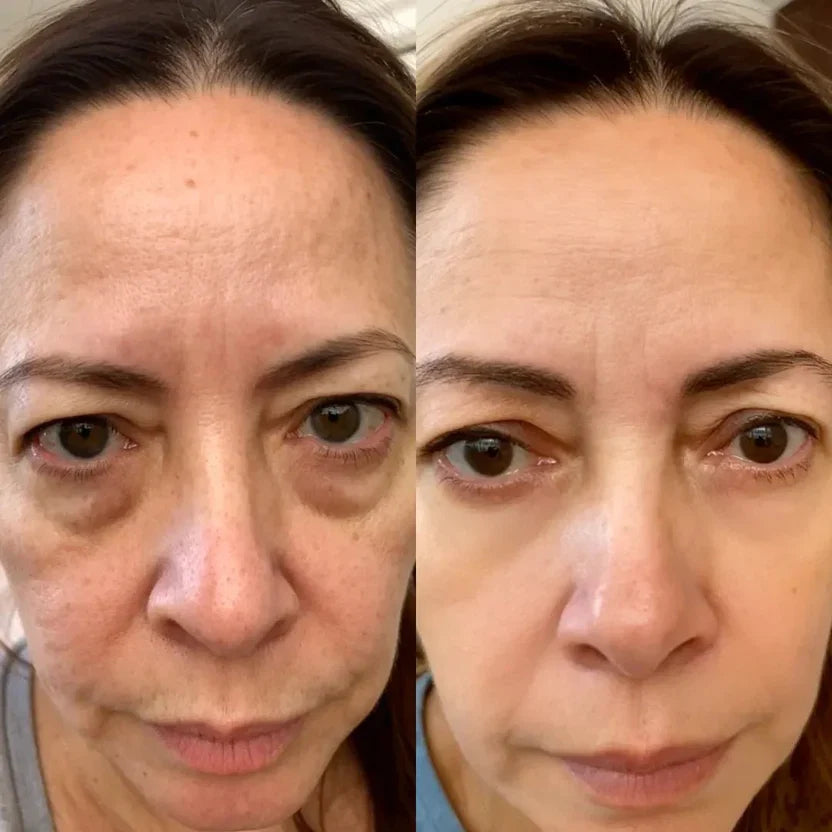 RevitalEyes® 2 en 1: Terapia de Luz Roja y EMS para Eliminar Bolsas de los Ojos